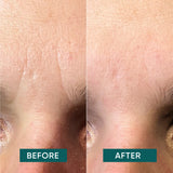 zornesfalte tapen vorher nachher