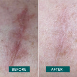 Scar Pads with Aloe vera - MINI