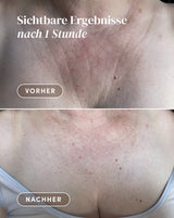 Decolleté Pad with Ectoin