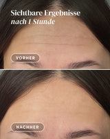 <tc>Forehead Pad with hexapeptide</tc>