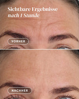 Forehead Pad with hyaluronic acid