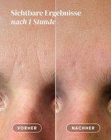 Vorher-Nachher-Ergebnis nach Anwendung der Hyaluron Zornesfalten Patches aus Bio-Baumwolle