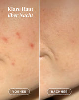 Pimples patches