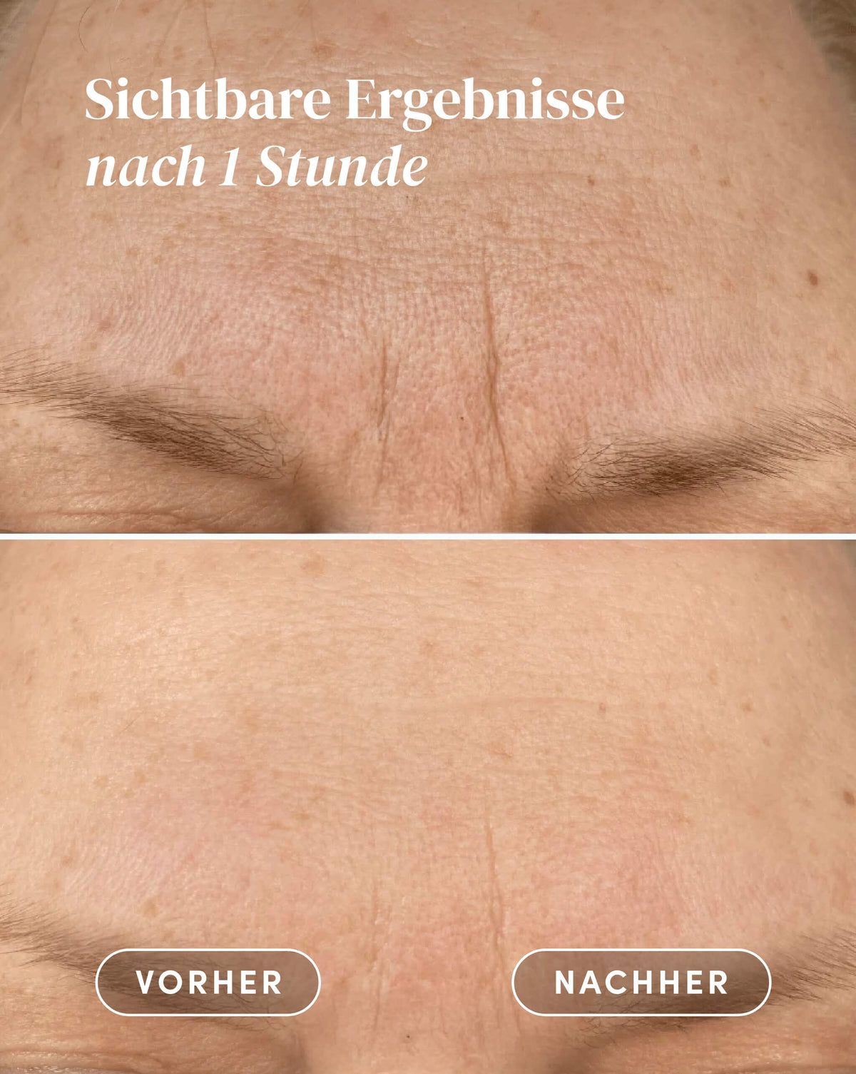 Vorher-Nachher-Ergebnis nach Anwendung des Vitamin C Stirn Pad