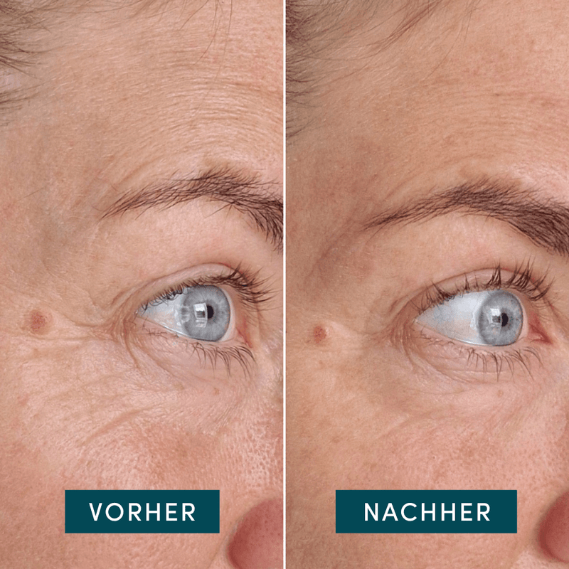 Eye temples pads with ectoin