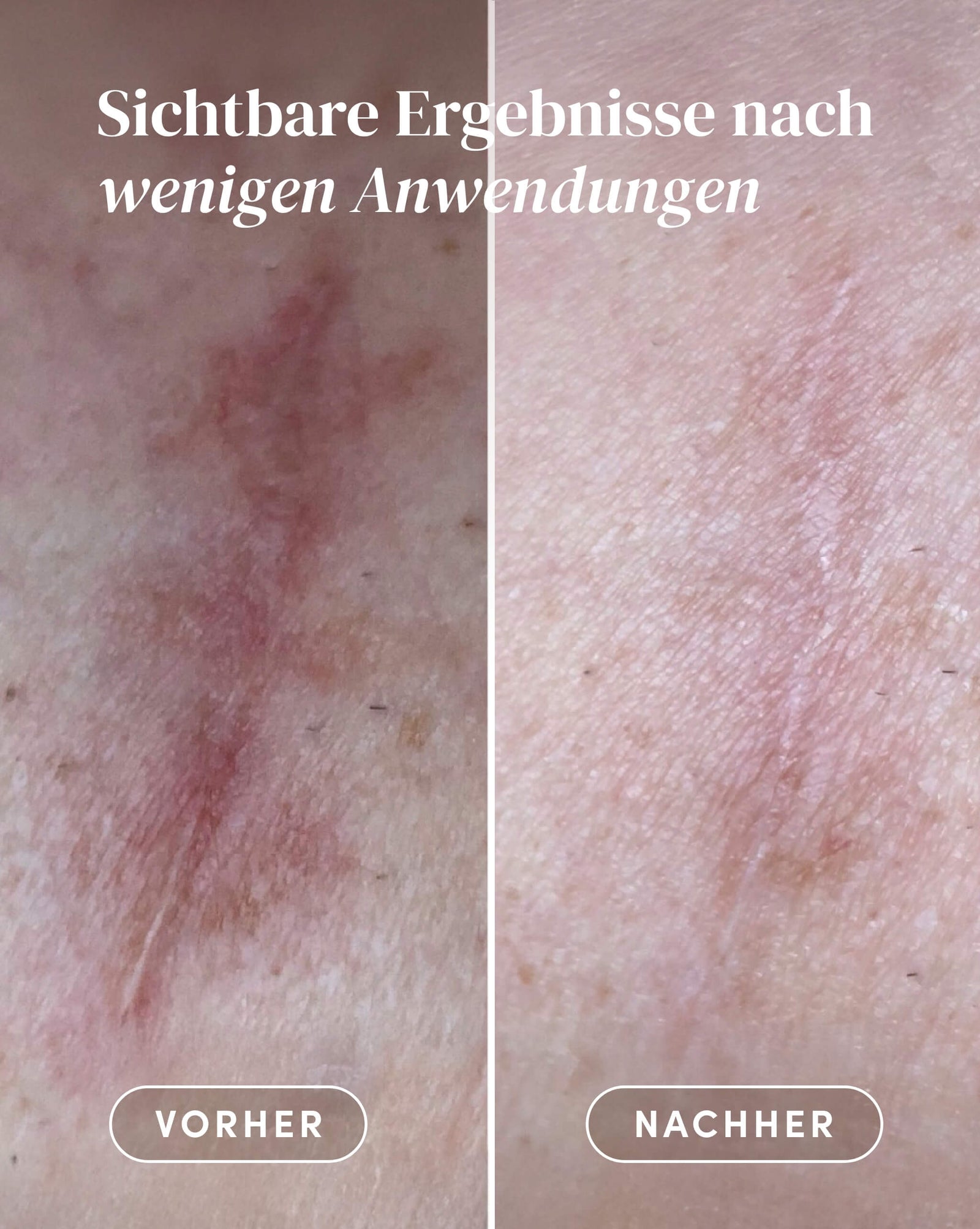 Mini Aloe vera Scar Pads