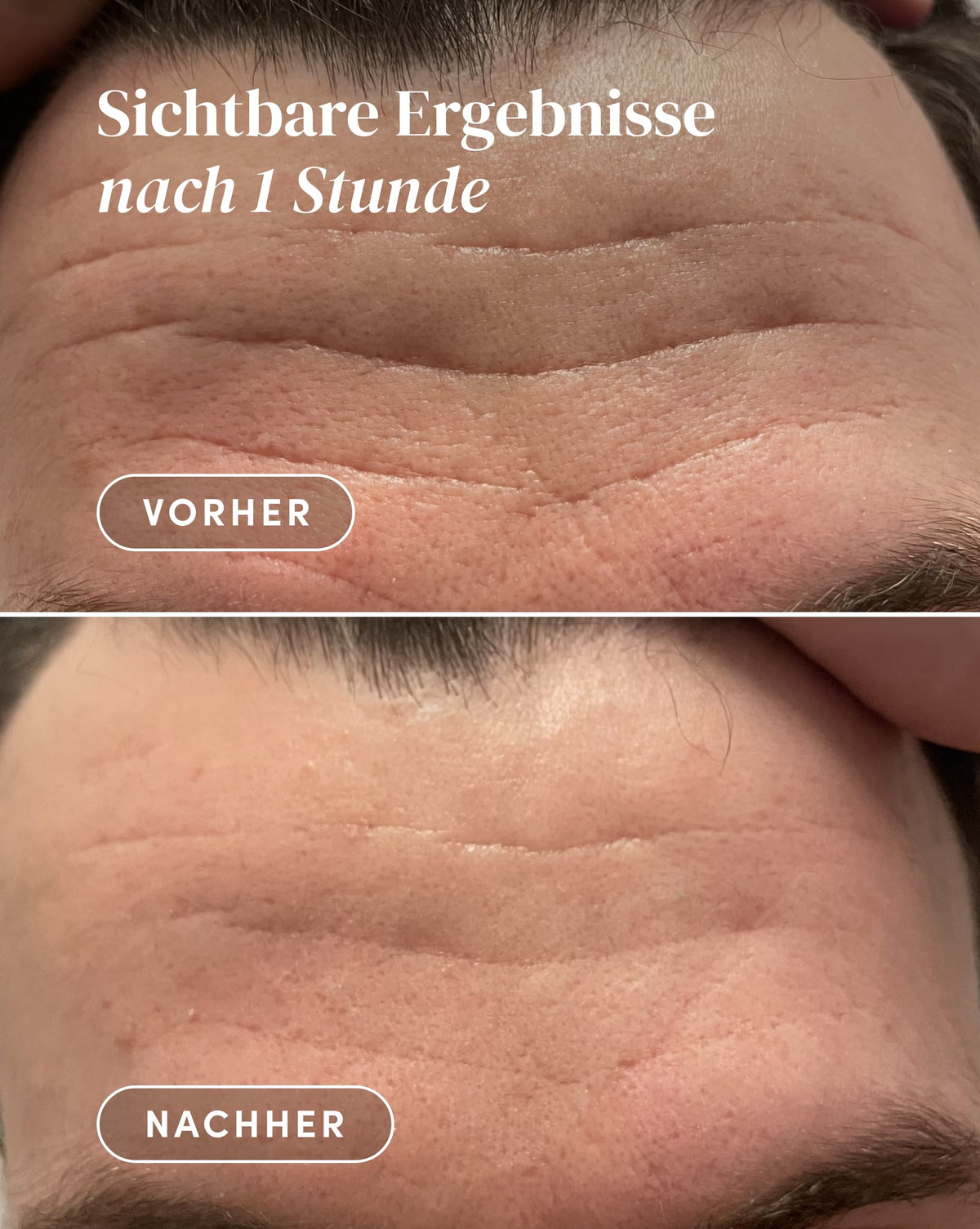 Vorher-Nachher-Ergebnis nach Anwendung der Aloe vera Zornesfalten Patches aus Bio-Baumwolle