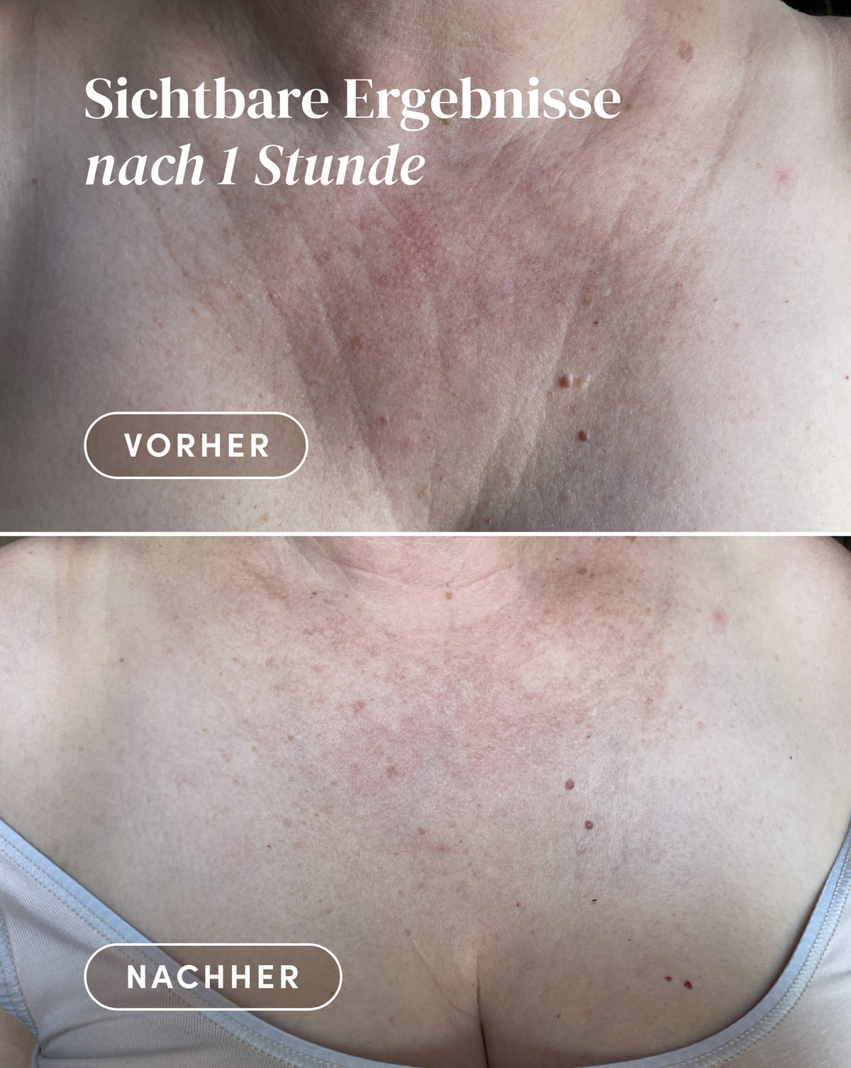 Vorher-Nachher-Ergebnis nach Anwendung des Ectoin Dekolleté Pad