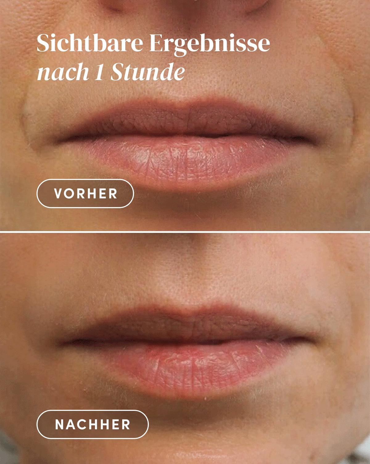 Vorher-Nachher-Ergebnis nach Anwendung der Ectoin Mund Patches aus Bio-Baumwolle