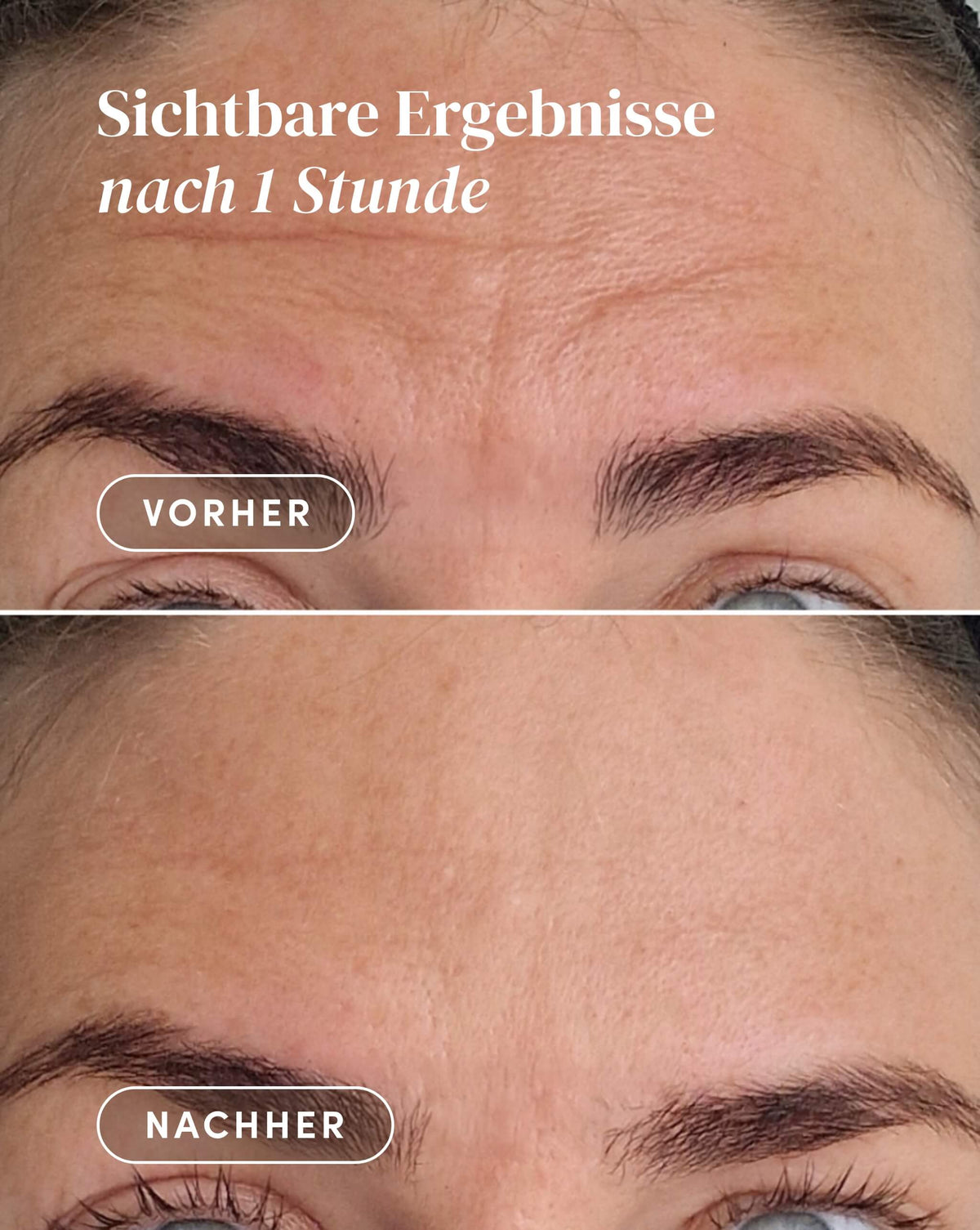 Vorher-Nachher-Ergebnis nach Anwendung des Ectoin Stirn Pad