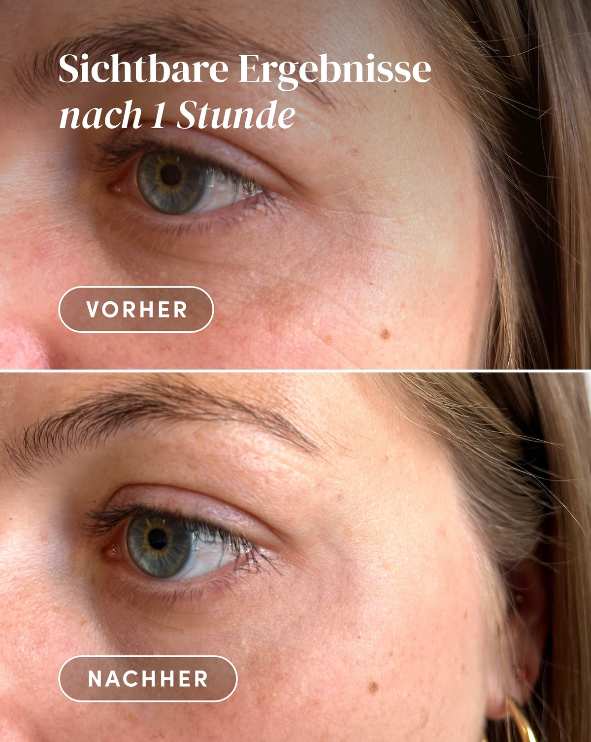 Vorher-Nachher-Ergebnis nach Anwendung der Hexapeptid-8 Augenpads