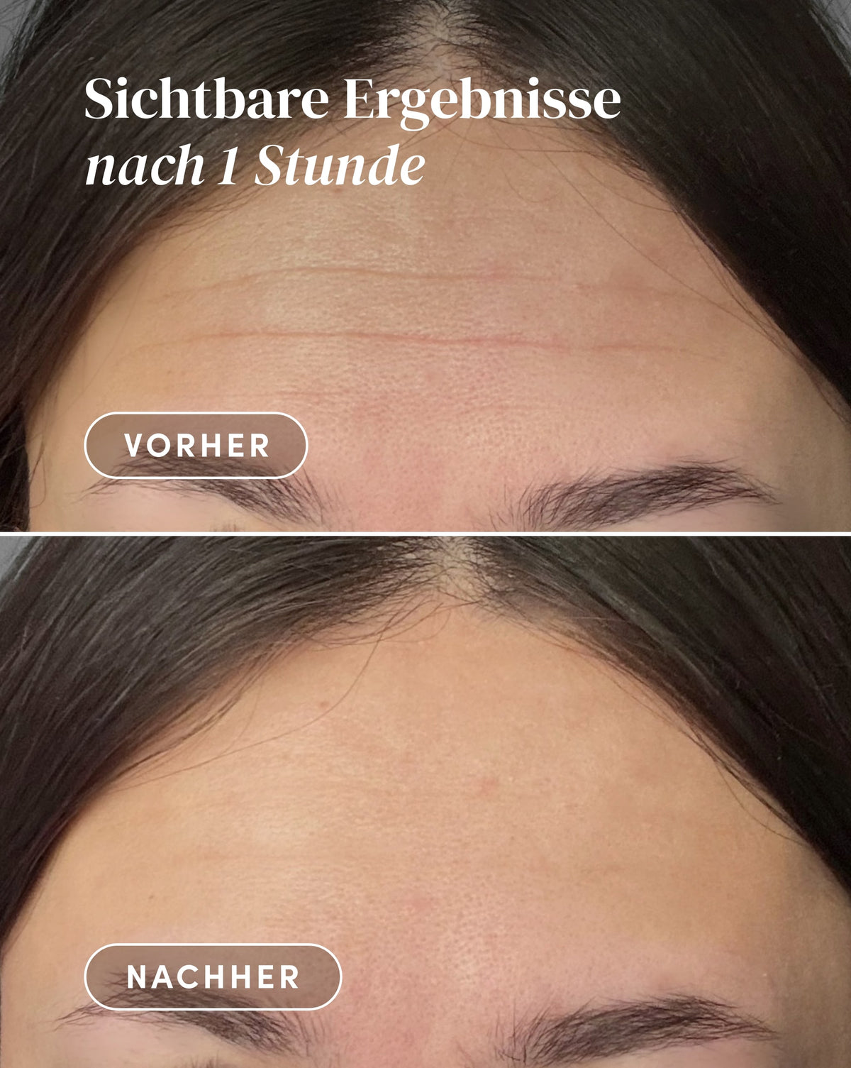 Vorher-Nachher-Ergebnis nach Anwendung des Hexapeptid-8 Stirn Pad