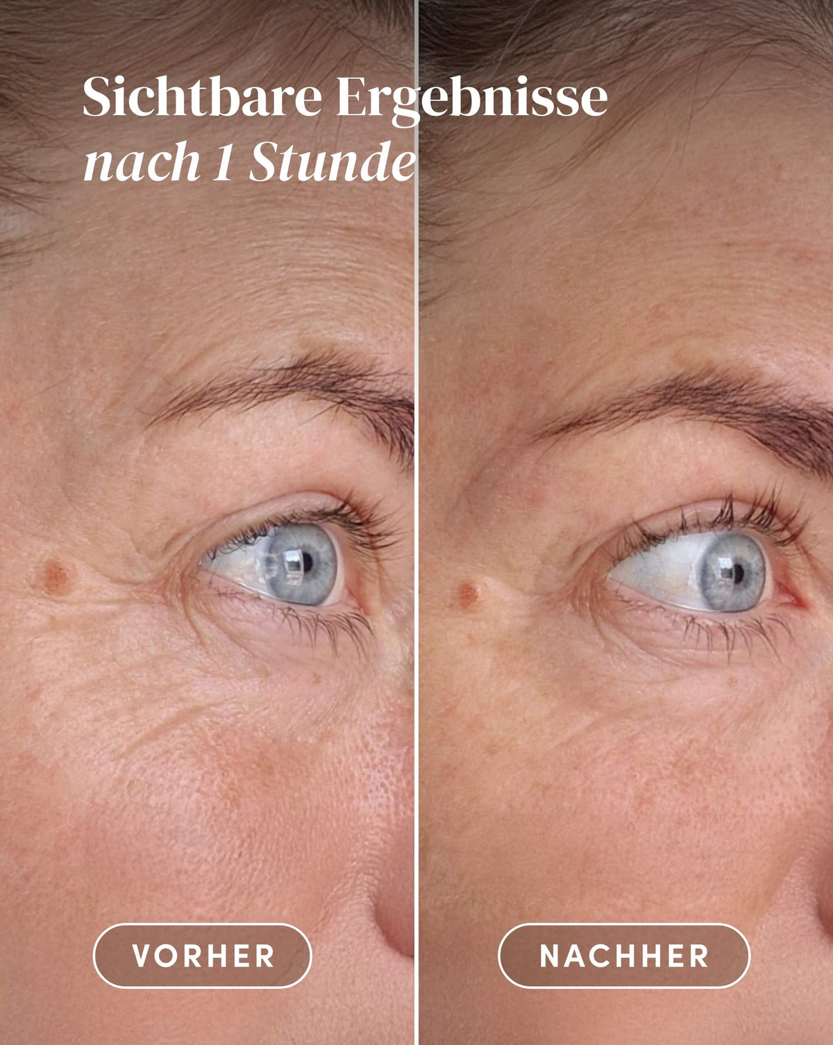 Vorher-Nachher-Ergebnis nach Anwendung der Hyaluron Augenpads