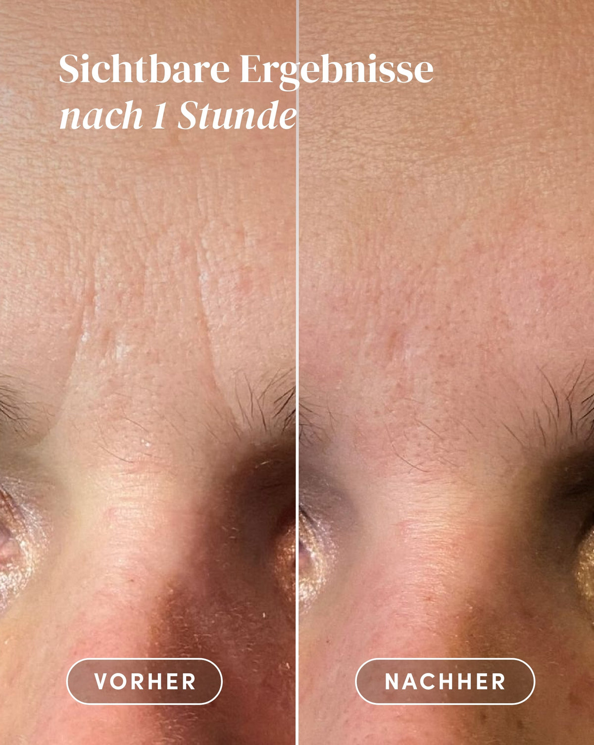 Vorher-Nachher-Ergebnis nach Anwendung der Hyaluron Zornesfalten Patches aus Bio-Baumwolle