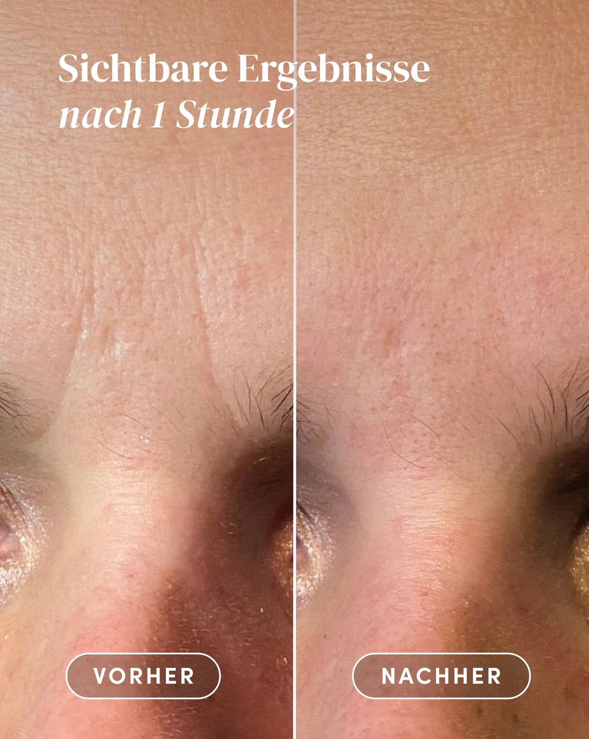 Vorher-Nachher-Ergebnis nach Anwendung der Hyaluron Zornesfalten Patches aus Bio-Baumwolle