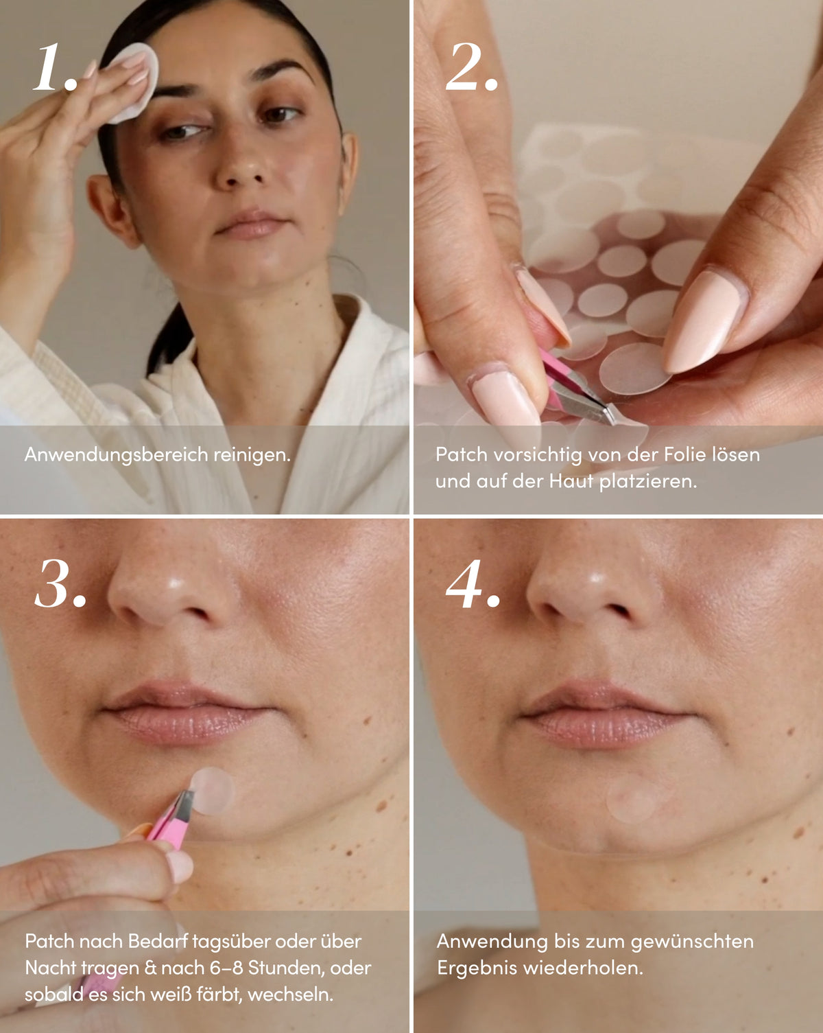 Anwendung der transparenten Post-Pickel Patches mit Alpha-Arbutin und Niacinamid an der Pickelpartie