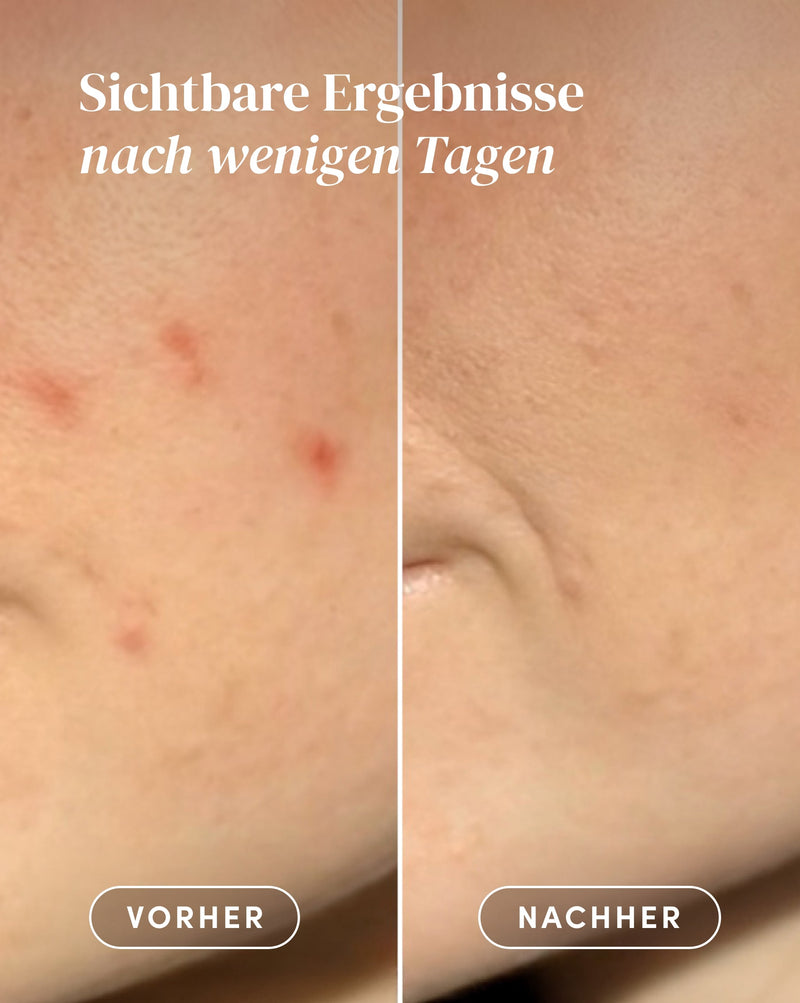 Post pimple patches