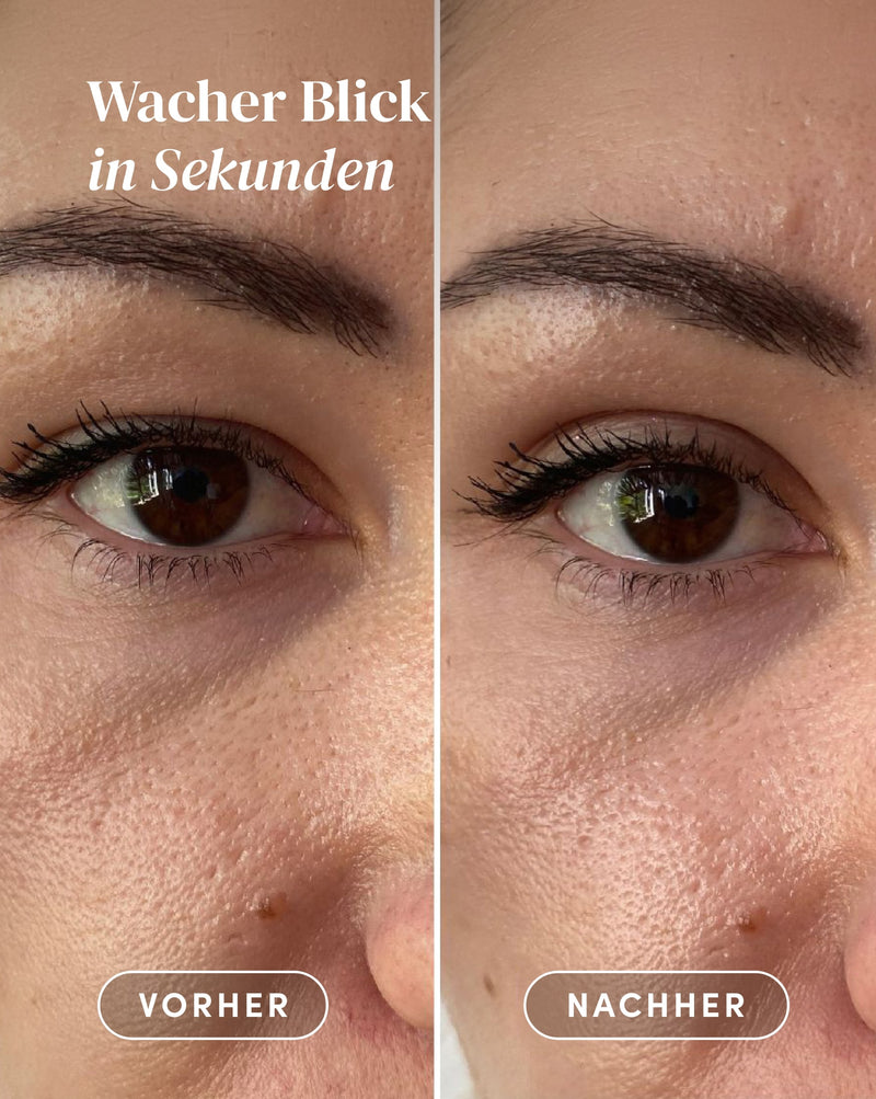 Droopy eyelid tapes